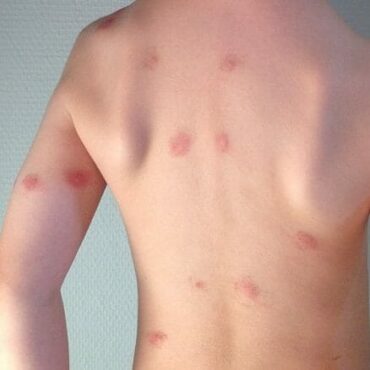 Mückenstich allergische Reaktion Strophulus