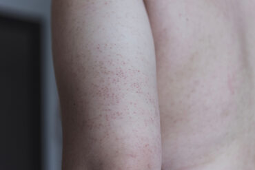 Keratosis pilaris in Form von kleinen roten Pickeln auf dem Arm 