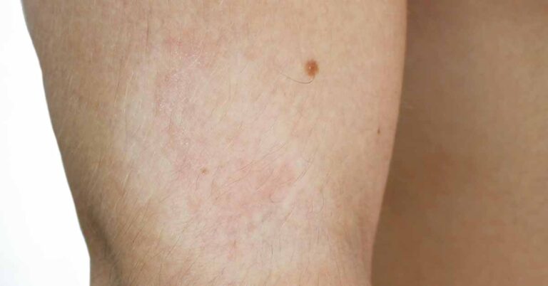Foto von helle Flecken auf der Haut, auch Pityriasis alba genannt