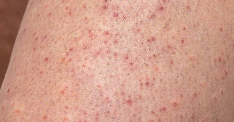 Foto von kleinen roten Pickel auf der Haut, die auch als Keratosis pilaris bezeichnet werden