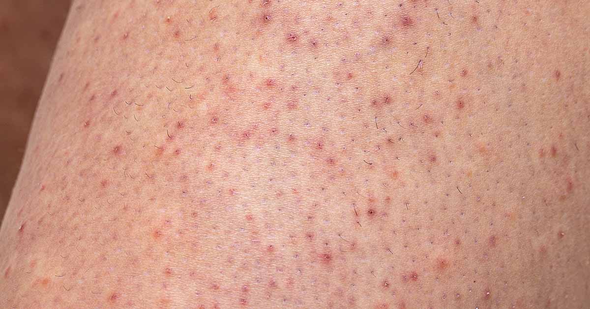 Keratosis pilaris (kleine rote Pickel an Oberarmen oder Beinen)