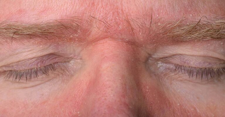 Foto eines Mannes mit seborrhoischem Ekzem im Bereich seiner Augenlider