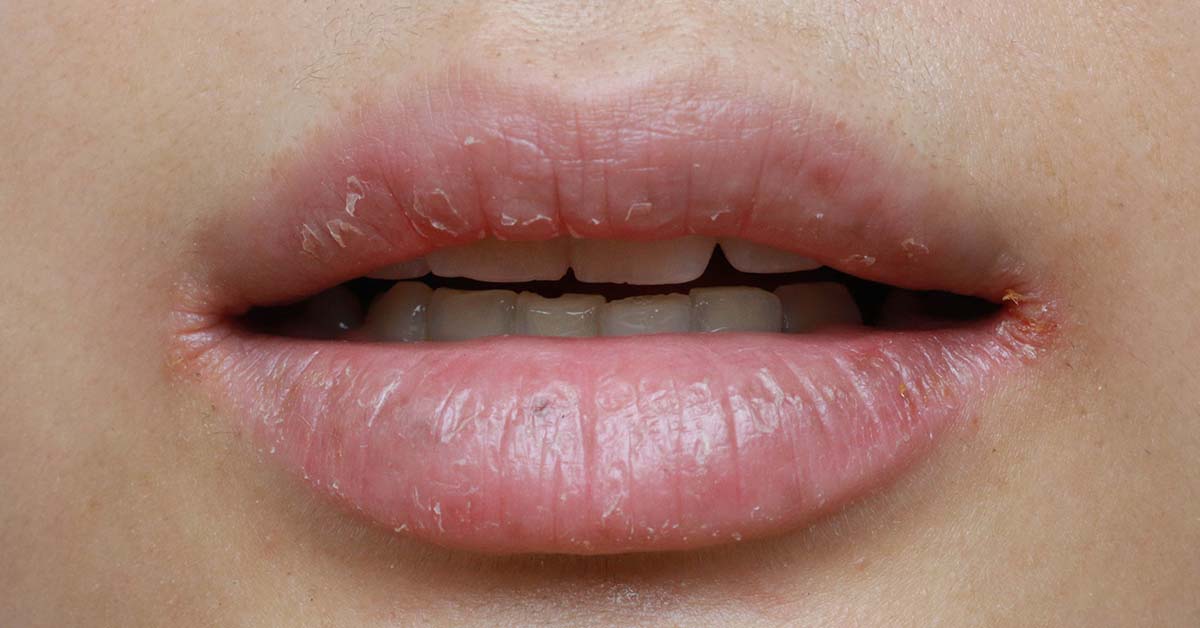 Trockene Lippen Ursachen und Pflege Dr Leenarts
