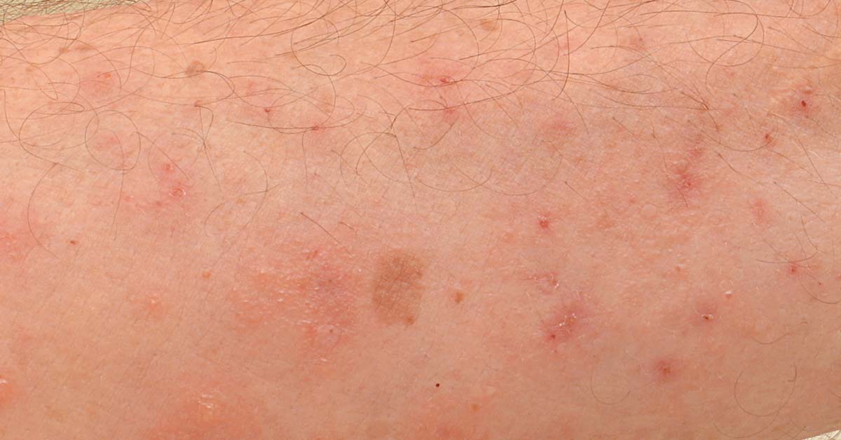 Anfangsstadium Wie Sieht Krätze Aus Am Anfang www.drleenarts.de