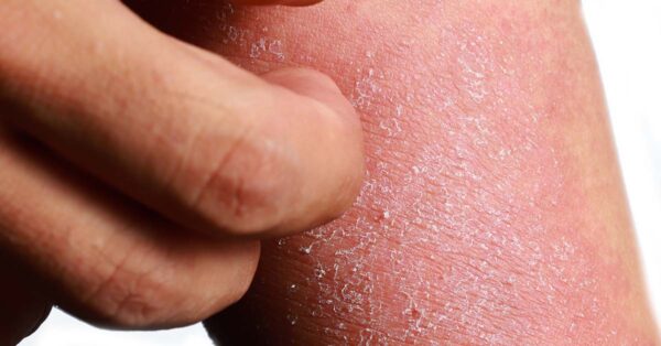 Helle Flecken auf der Haut | Ursache & Tipps | Dr Leenarts