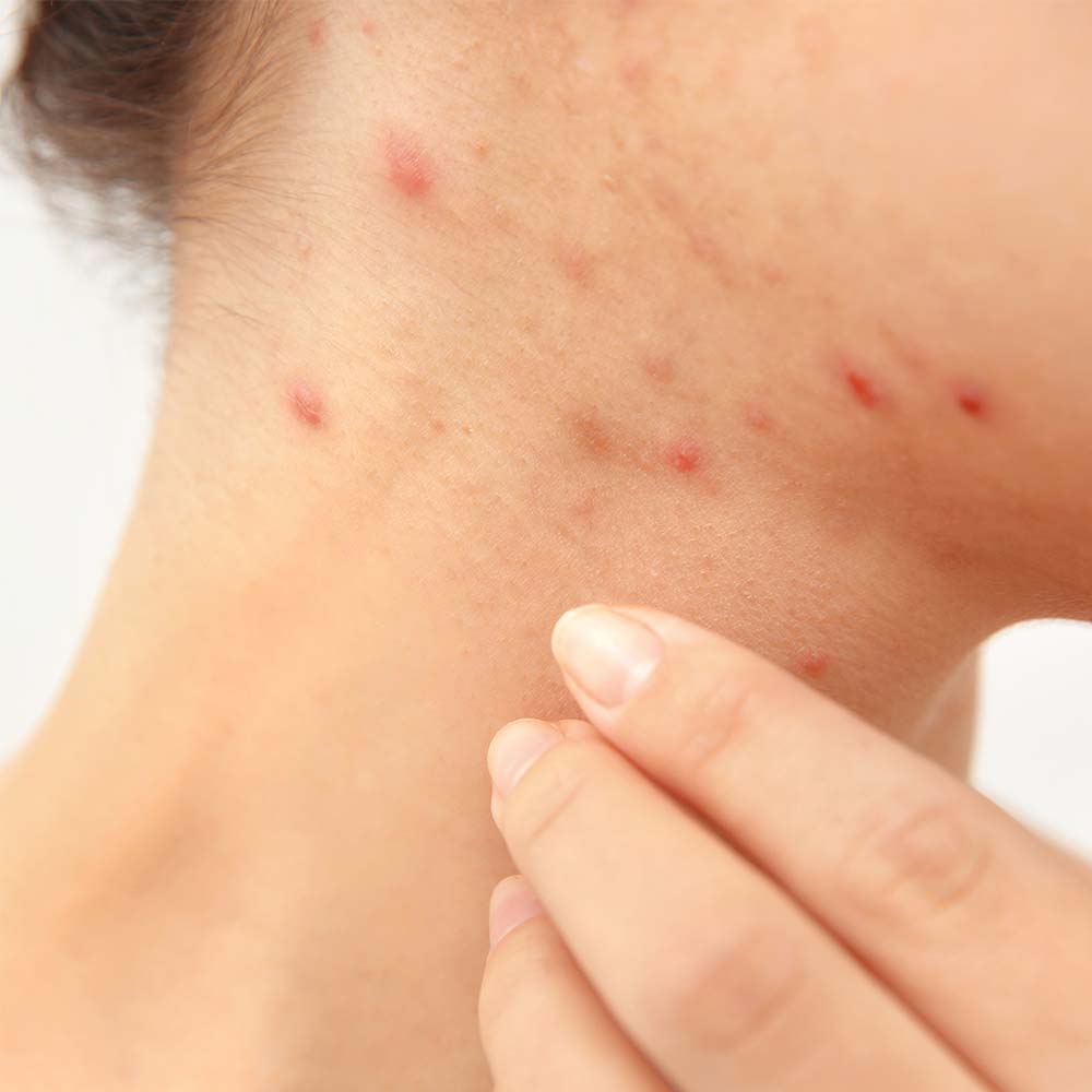 Neun Tipps von deiner Dermatologin zum Thema Akne