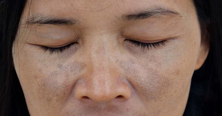 Foto einer Frau mit Melasma im Gesicht und braunem Haar